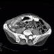 Acute enterocolitis, enteritis and colitis: CT - Computed tomography